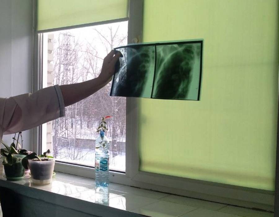 22 жителя Бердска госпитализированы в отделение пульмонологии