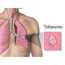 Туберкулез относят к социальному заболеванию
