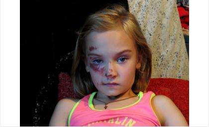 Первоклассница Ульяна получила травмы на детской площадке в Бердске
