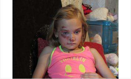 Первоклассница Ульяна получила травмы на детской площадке в Бердске