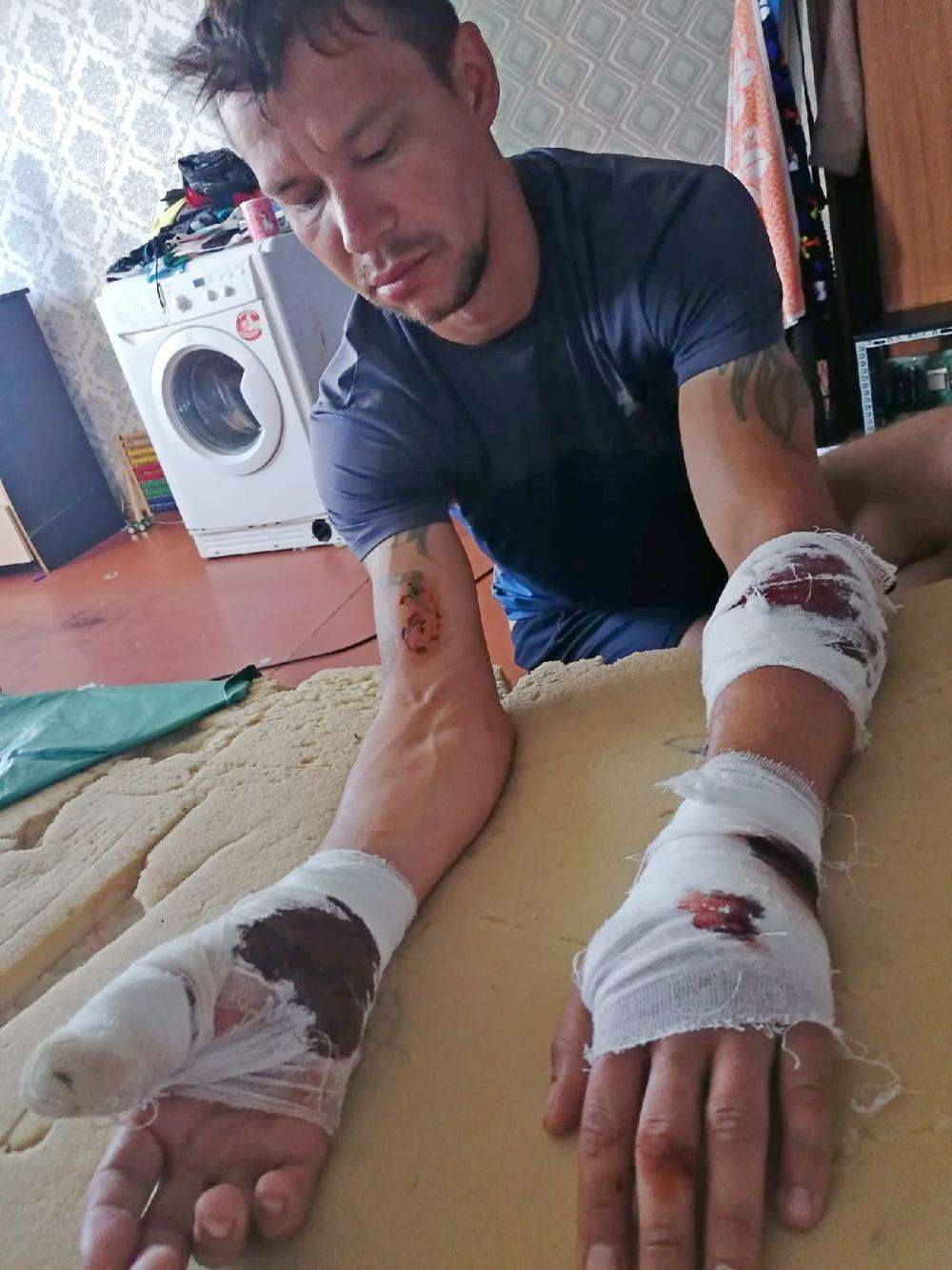 «Отнимаются два пальца, сухожилия задеты» - ротвейлер чуть не разорвал жителя Бердска