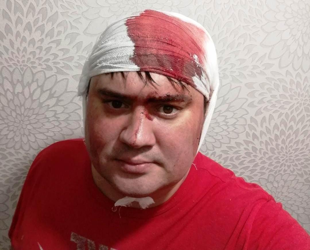 «Вышел из лифта и почувствовал резкий удар»: Тренер из Новосибирска стал случайной жертвой в пьяной драке