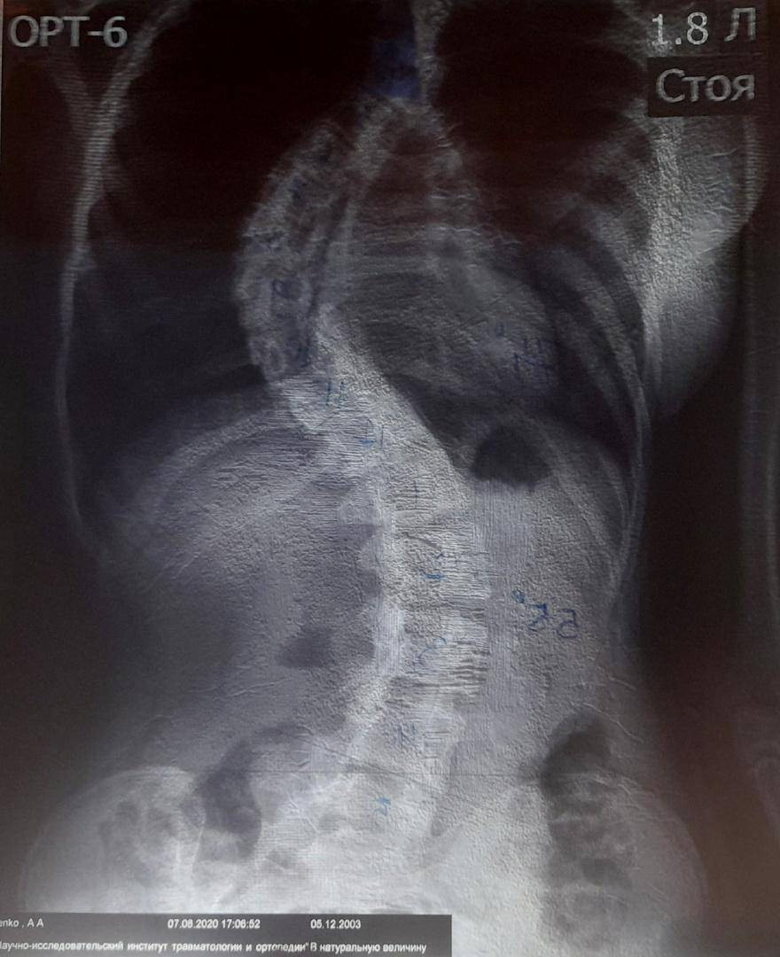 Нарушения осанки и сколиоз – как делают операции в НИИТО и как проходит  восстановление пациентов?