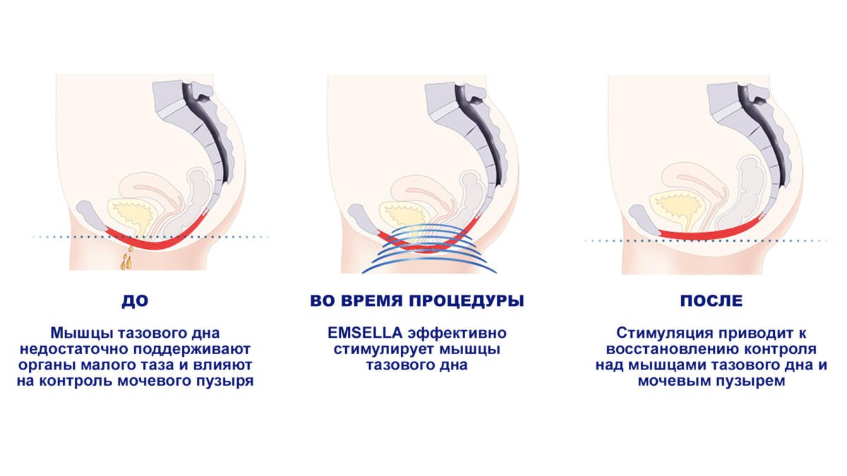 Кресло для тренировки мышц тазового дна