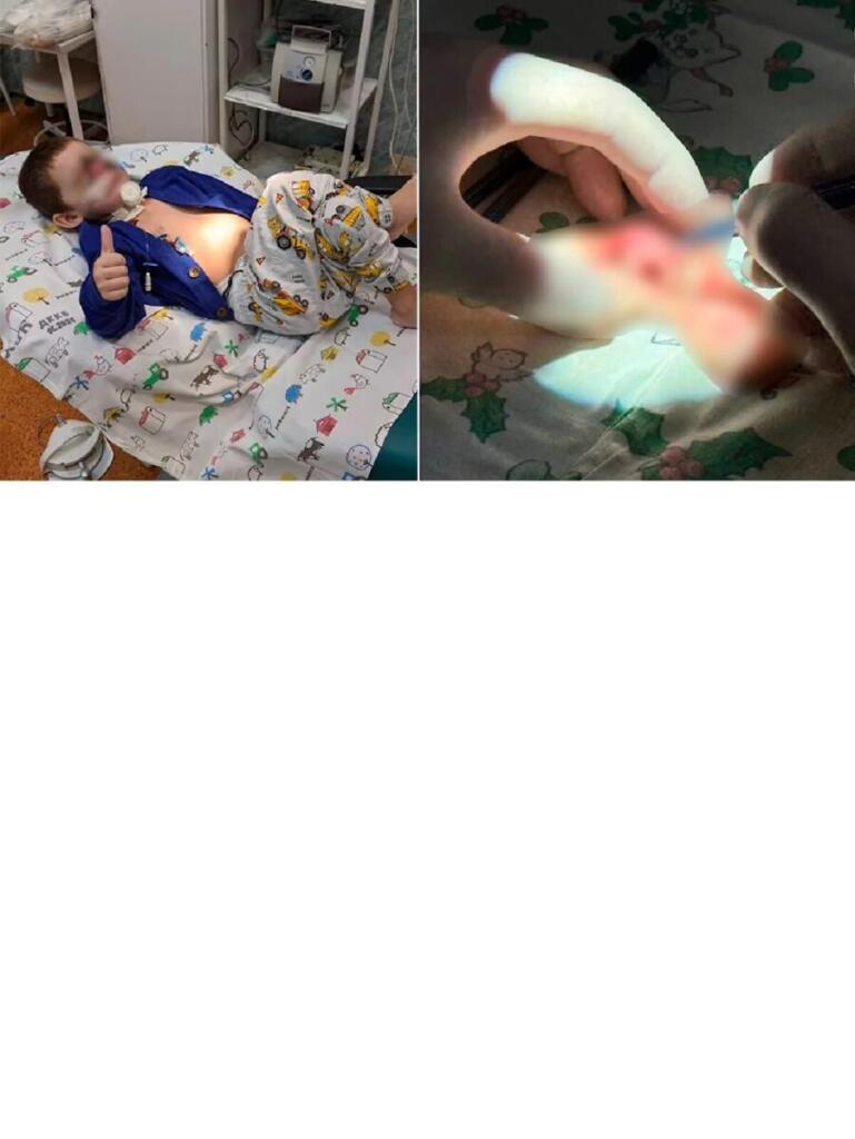 Мальчика оперировали 12 часов