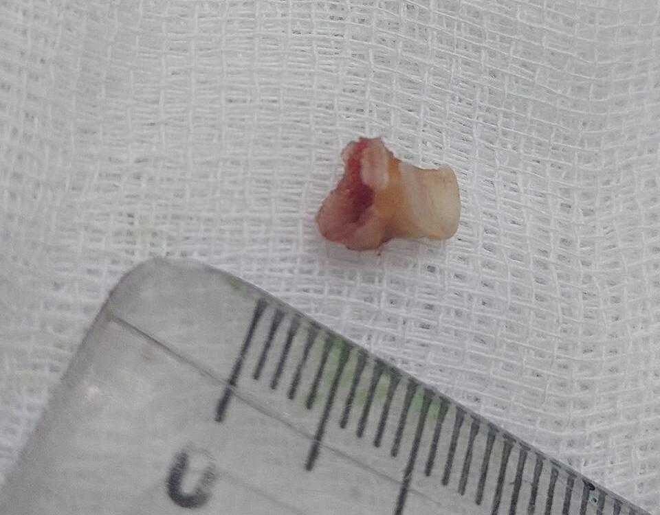 Зуб извлекли из бронхов